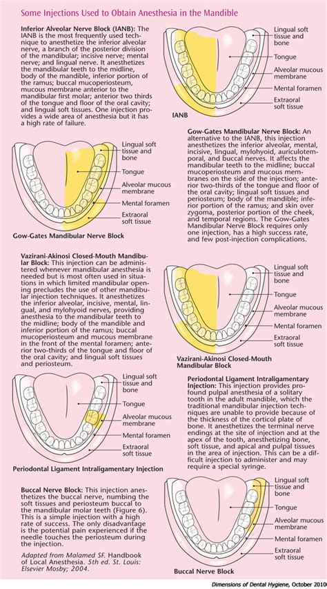 Achieve Anesthesia Success in the Mandible - Dimensions of Dental Hygiene