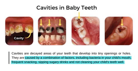 Cavities in Baby Teeth: Signs, Causes, & Treatment - Share Dental Care