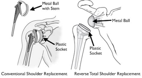 ACE Physical Therapy and Sports Medicine Institute in Falls Church ...