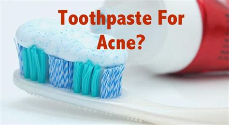 Toothpaste On Acne - Does It Help?