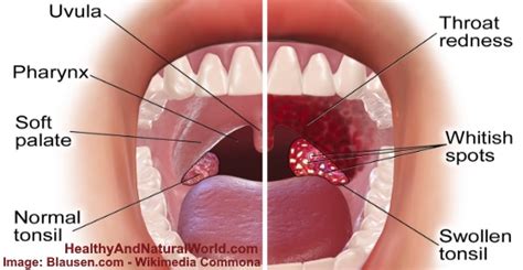 Causes of White Spots on Throat Based on Science (Images Included)