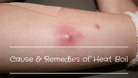 Heat Boil - Causes, Symptoms and Easy Home Remedies - Food N Health