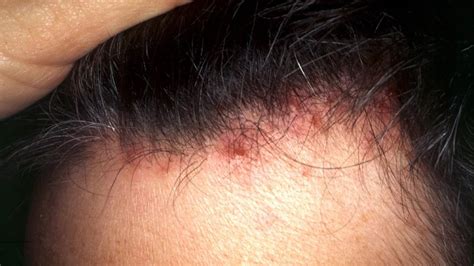 Scalp folliculitis: Symptoms, pictures, causes, shampoos and creams