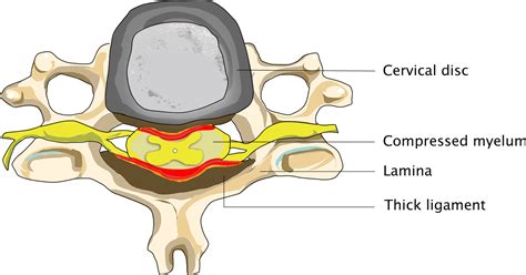 Cervical spinal stenosis - Conditions - Dr. Schröder