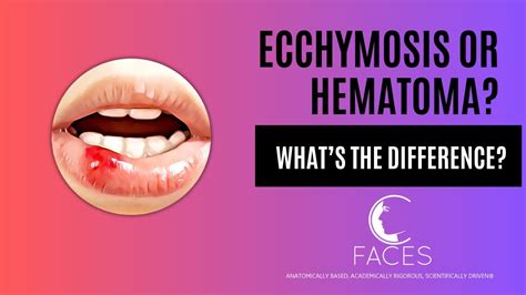 What's the difference between a Bruise (ecchymosis) and a hematoma? - YouTube