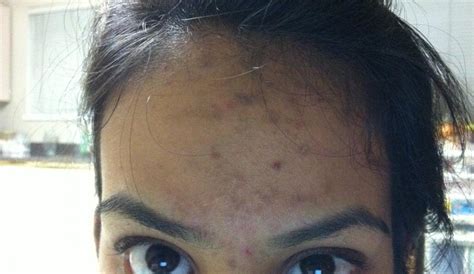 Pic - Terrible Acne Scarring On Forehead! Help Please! - Scar treatments - Acne.org Community