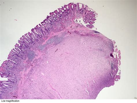 Fibroepithelial Polyp Histology