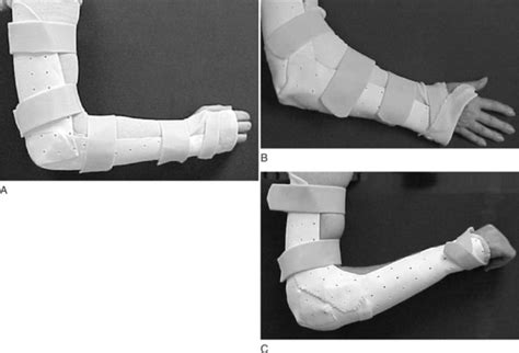 Elbow Immobilization Splints | Musculoskeletal Key