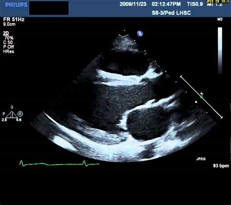 Echocardiography Parasternal Long Axis - YouTube