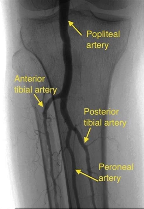 Popliteal angiogram – All About Cardiovascular System and Disorders