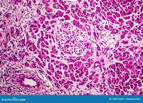 Acute Hemorrhagic Pancreatitis Stock Photo - Image of hematoxylin, histology: 120411052