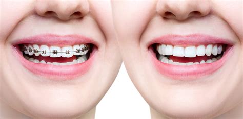 How to Choose Between Traditional Dental Braces or Invisalign® - 23 Smiles