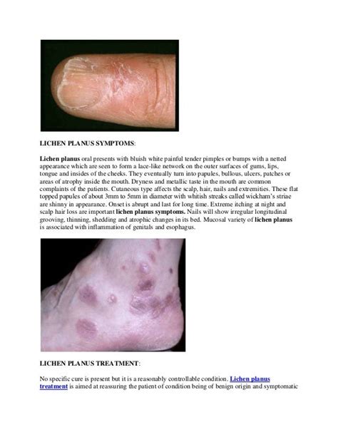 Lichen Planus Treatment, Diagnosis, Symptoms, Causes of Lichen Planus