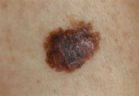 Skin Cancer: Signs, Symptoms, and Complications