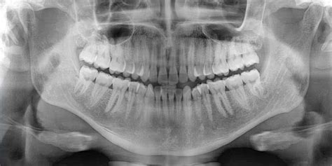 The Role Of X-Rays In Periodontal Disease Diagnosis - Upper East Side ...