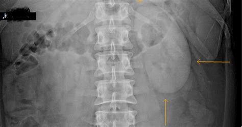 Dense Persistent Nephrogram -- Causes - Sumer's Radiology Blog