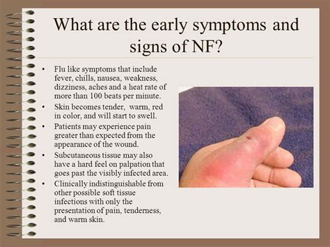 Necrotizing Fasciitis Early Stages