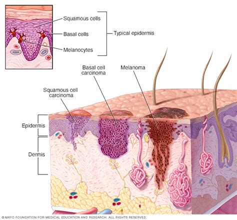 Squamous cell carcinoma of the skin - Symptoms and causes - Mayo Clinic