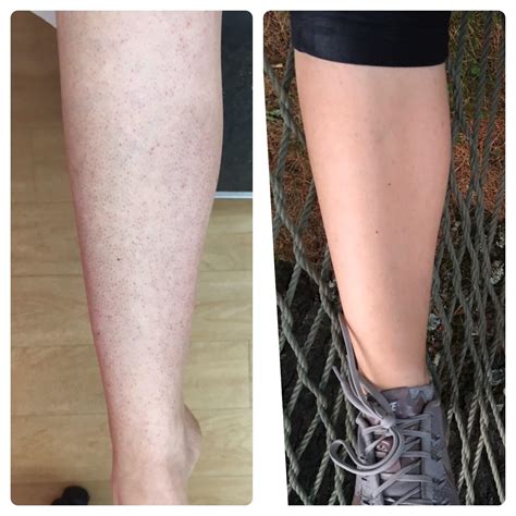 [B&A] Made an account to share the progress I've made on KP (Keratosis ...