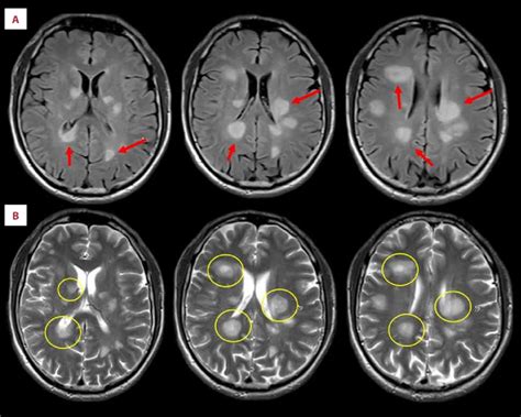 Brain Magnetic Resonance Imaging Mri Revealed An Old - vrogue.co