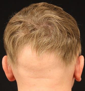 Ophiasis Alopecia: Causes, Symptoms and Treatments