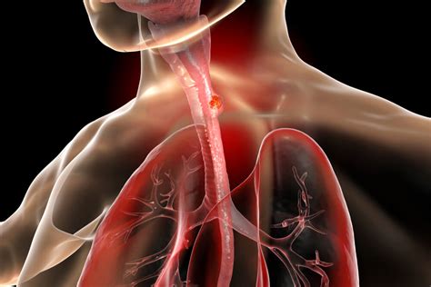 Symptoms of the Most Significant Esophagus Diseases