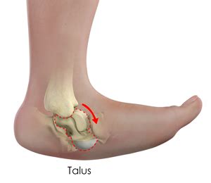 Congenital Limb Deformities South Central | Congenital Vertical Talus Kentucky