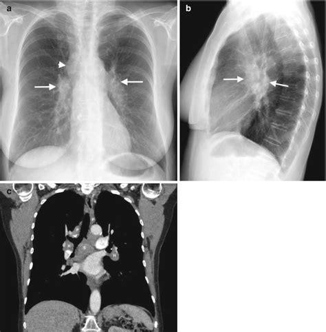 Fig. 1.4, [(a–c) Sarcoidosis manifesting as bilateral...]. - Diseases of the Chest, Breast ...