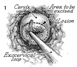 Conization of the Cervix by the Loop Electrical Excision Procedure (LEEP)