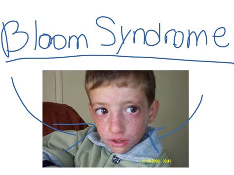 ShowMe - bloom syndrome