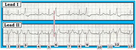 ECG Interpretation: ECG Interpretation Review #67 (PAC – PVC – 12 Leads Better than One)