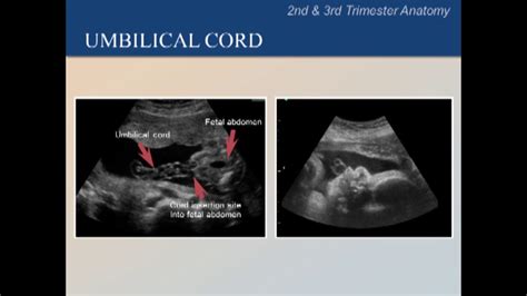 Umbilical cord ultrasound - YouTube