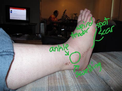 Peroneal Tendon Surgery Blog: A momentous day