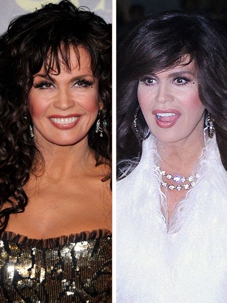 Chatter Busy: Marie Osmond Plastic Surgery