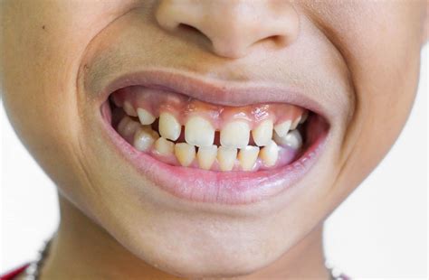 Why Haven't All My Child's Baby Teeth Come In? | CDC Memphis