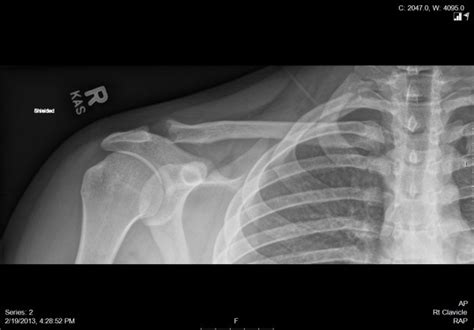 Distal clavicle Osteolysis Symptoms, Diagnosis and Treatment | Bone and ...