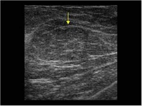 Lipoma Ultrasound