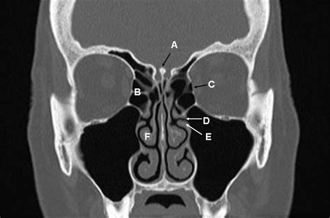 Coronal computed tomogram through the paranasal sinuses | The BMJ