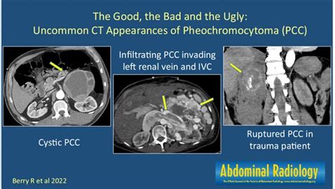 The good, the bad, and the ugly: uncommon CT appearances of ...