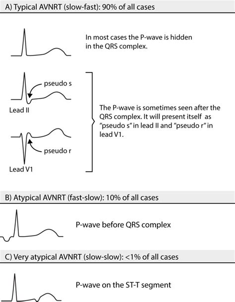 Atrioventricular nodal reentry tachycardia (AVNRT) – ECG learning