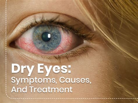 Dry Eyes: Symptoms, Causes, Risk Factors, Treatment And Prevention ...