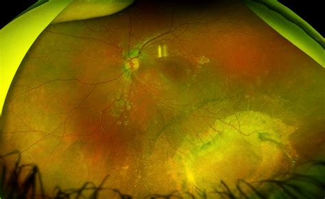 Mystery Diagnosis: X-Linked Retinoschisis — Matt Weed, MD Spokane Pediatric Ophthalmologist