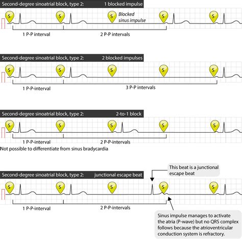 Sinoatrial block (SA block): ECG criteria, causes and clinical features – ECG learning