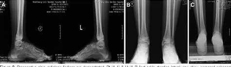 Figure 3 from Treatment of Calcaneovalgus Deformity Following Operative Treatment of Diplegic ...