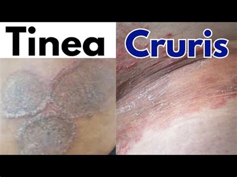 Tinea Cruris jock itch | Tinea cruris symptoms, treatment | Jock itch fungal infection