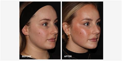 Emface Before and After Photos: Are the Results Worth It? | RealSelf News