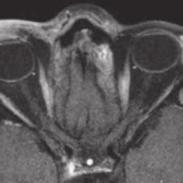 MRI showing inflammatory tissue swelling and granulation tissue at the ...