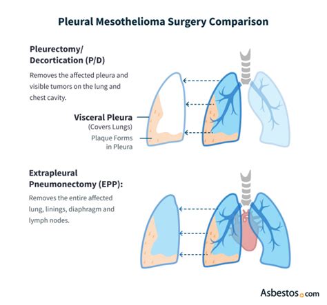 Pleurectomy vs Pneumonectomy: What Are The Differences?