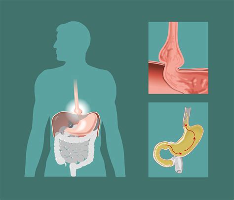 What is a Hiatal Hernia? - Houston Heartburn and Reflux Center