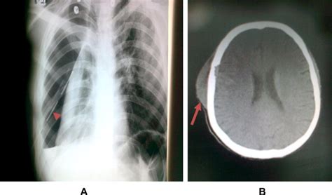 (A) Chest X-ray showing post ICT. (B) Cold abscess right scalp (red... | Download Scientific Diagram